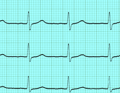 心电图心电图