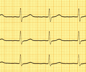 心电图心电图