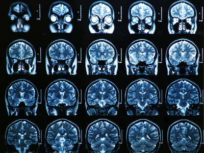 侧脑室磁共振成像大脑扫描照片