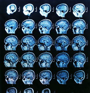 磁共振成像大脑扫描图片