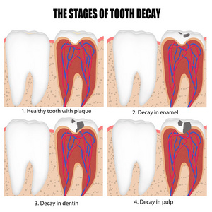 牙龋各阶段的关系图