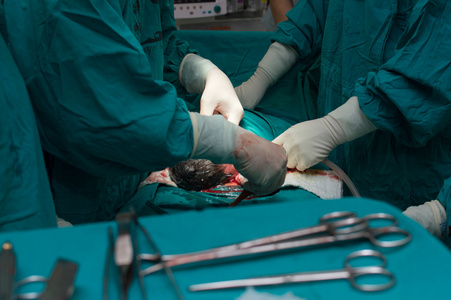 剖腹产过程图片