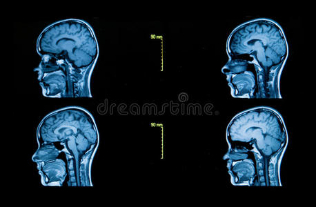 大脑的计算机断层扫描图像