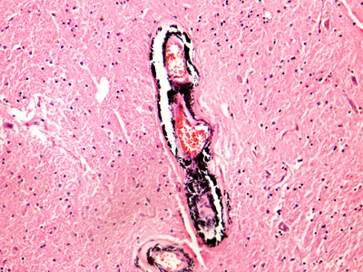 动脉中膜钙化的人类大脑的船只图片