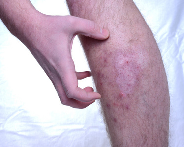 肠黑病皮肤瘙痒病照片