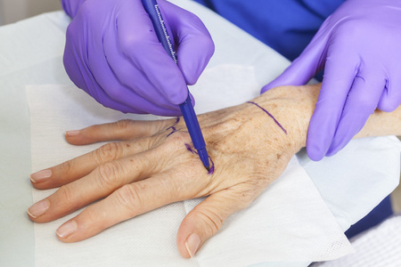 整形外科医生手术标志着女人的手