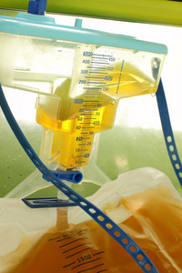 耻骨上膀胱穿刺袋收集尿液照片