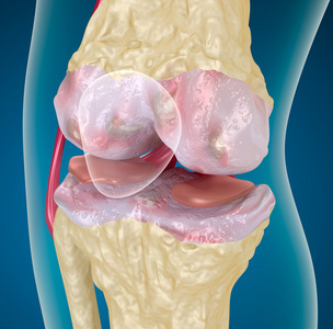 骨关节炎 膝盖