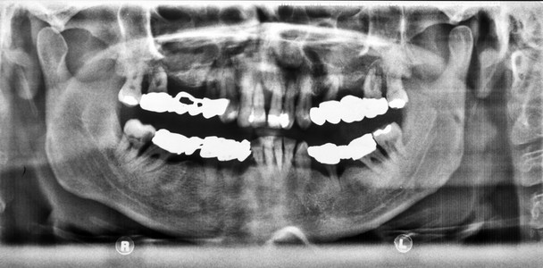 全景 x 射线图像的牙齿