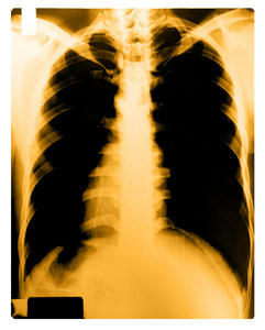人体胸部的 x 射线图像