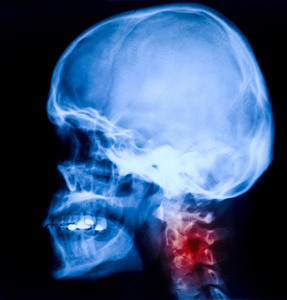 颅骨的x 光照片照片 正版商用图片1jpm5h 摄图新视界