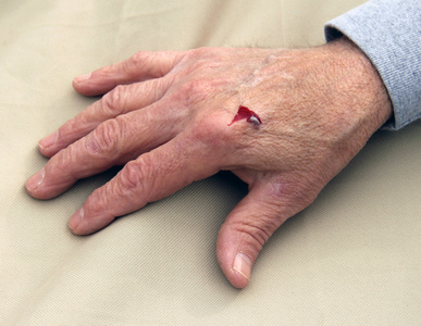 伤到撕裂伤到右手照片