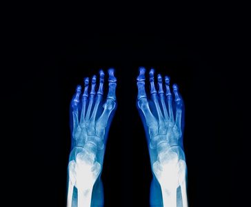 x 射线的脚