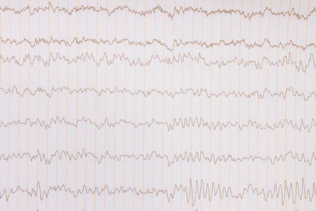 EKG pozad