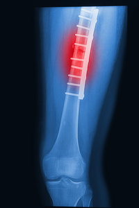 用植入物板和螺钉破坏人体大腿x射线图像