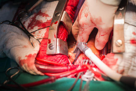 纤颤二尖瓣成形术在左房颤封堵术中的应用照片