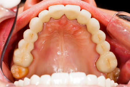 烤瓷牙在人类的嘴烤瓷牙照片