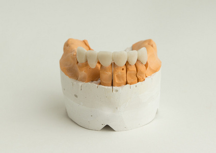 牙科烤瓷冠