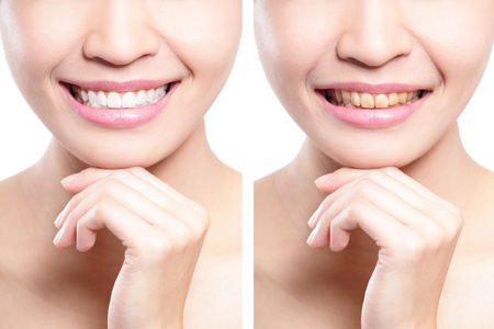 女人牙齿美白前后照片