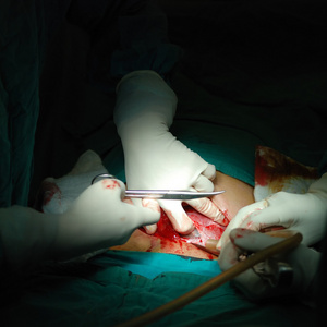 剖腹产过程图片