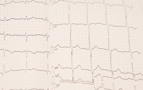 心脏节律图表背景使用