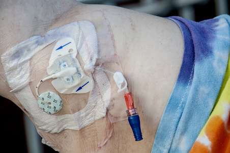 picc置管图片-picc置管素材-picc置管插画-摄图新视界