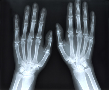 人类的手骨头射线照相摄影图