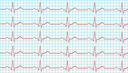 正常窦性心律图片