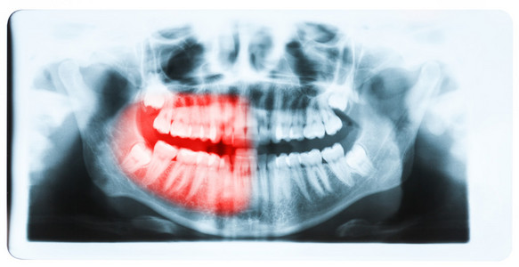 全景 x 射线图像的牙齿和口腔与所有四个磨牙 ve