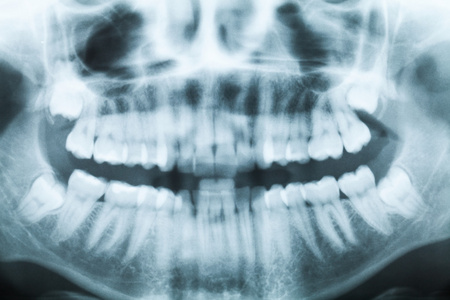 特写 x 射线图像的牙齿和口腔与全部四个磨牙垂直