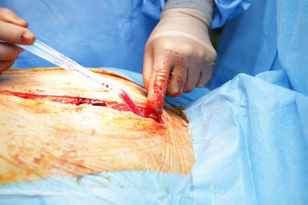 外科伤口外科医生的手在伤口血液中照片