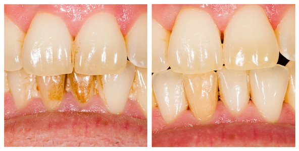 beforeafter 斑去除