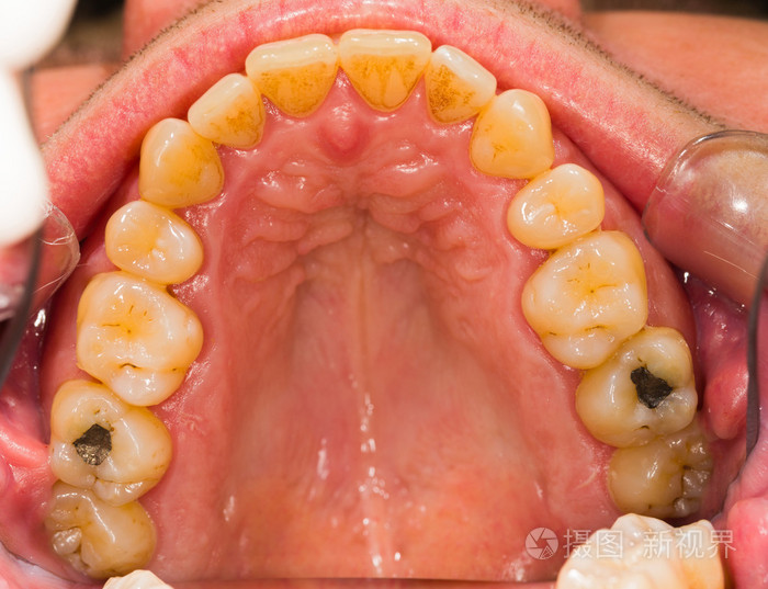 前牙菌斑清除jpg