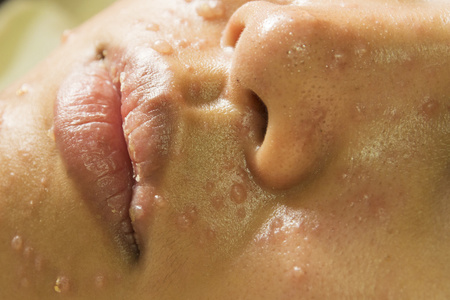 脸部长痘脸上的水痘照片