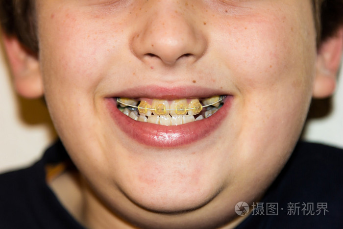 大括号和洁白的牙齿的微笑的男孩