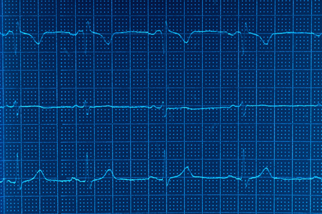 心电图心电图图片
