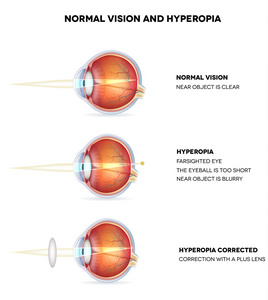 Hyperopie und normalem Sehvermgen. Hyperopie ist weitsichtig se
