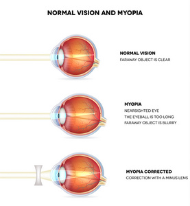 近视和正常视力。近视是短视