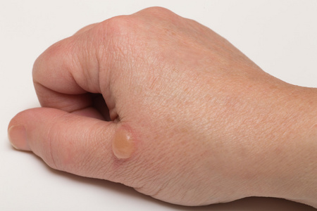 起泡的皮肤照片