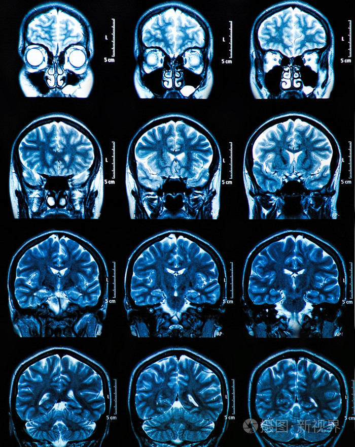 磁共振成像大脑扫描