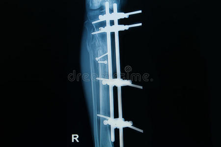 小腿胫骨骨折伴植骨x线影像学研究