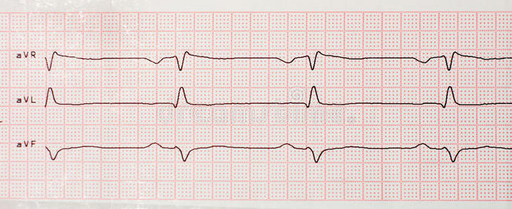 心电图结果