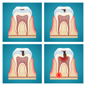 阶段进展龋齿和牙痛图片