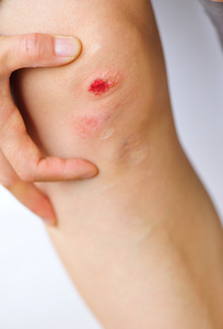 儿童手指受伤受伤的膝盖照片