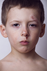 受伤的脸的小男孩，公鸡在战斗以后关闭