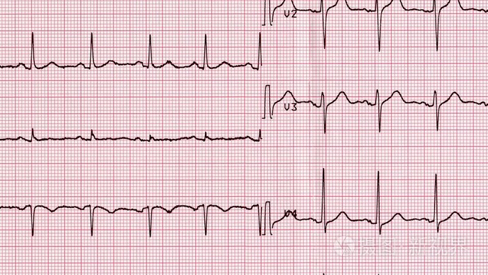 心电图学的心脏的跳动