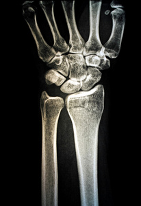 人类的手的 x 射线图像