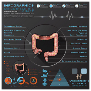 大肠癌和排泄解剖系统医疗信息图表