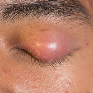 眼睛盖子脓肿麦粒肿照片