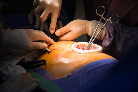 视频协助开胸手术照片